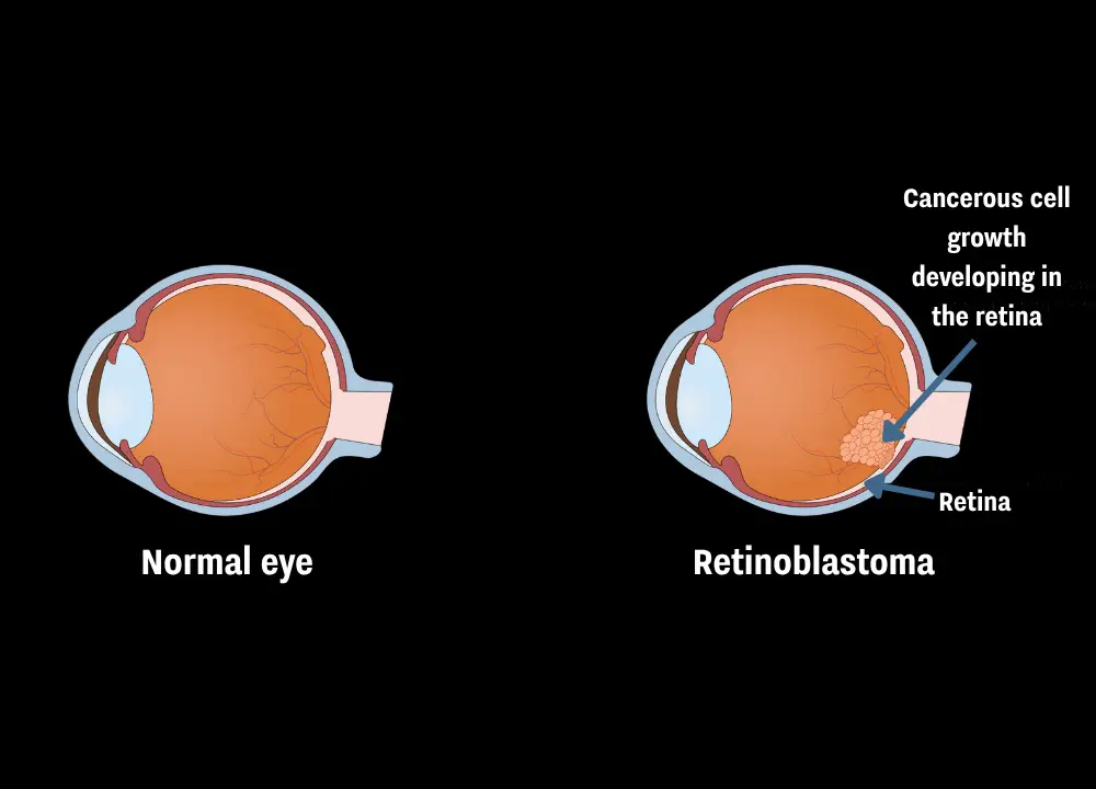 The difference between a normal eye and an eye with retinoblastoma (Getty Stock Images)