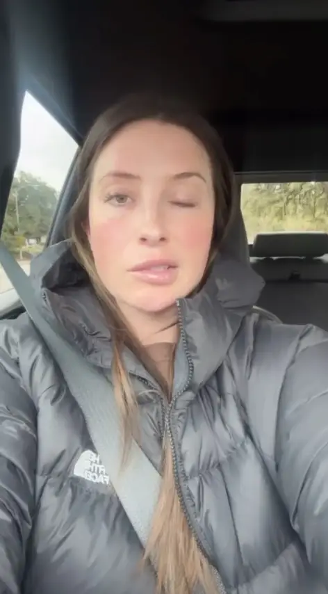 Bristol Palin had been experiencing facial paralysis on the left side of her face (Instagram/@bsmp)