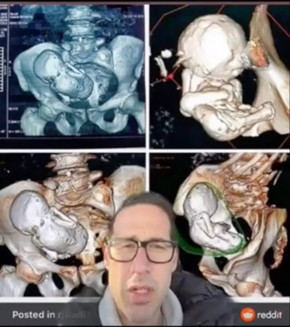 The woman had a 'stone baby' growing in her abdomen.