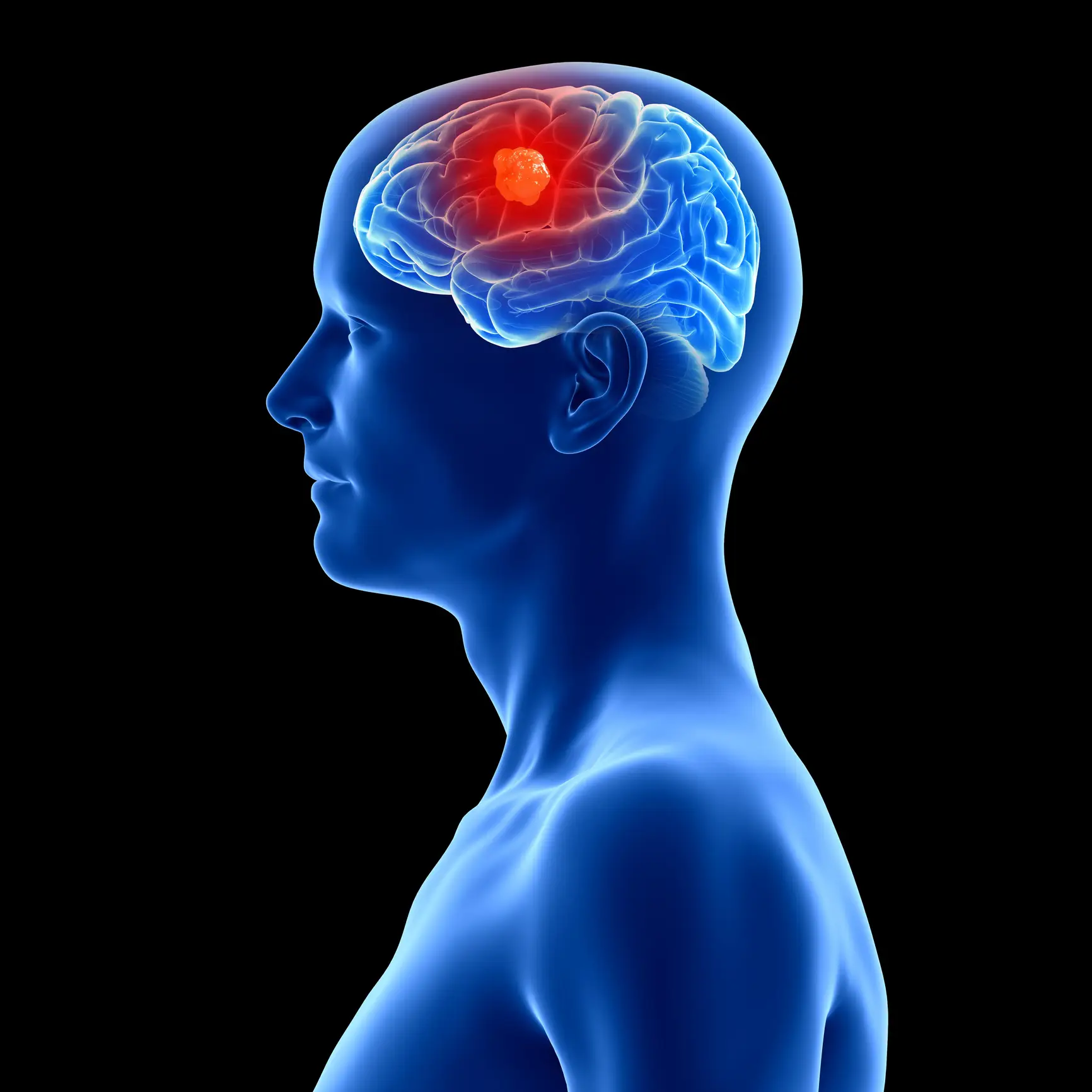 Brain cancer can result in a numerous amount of symptoms (Getty stock images)