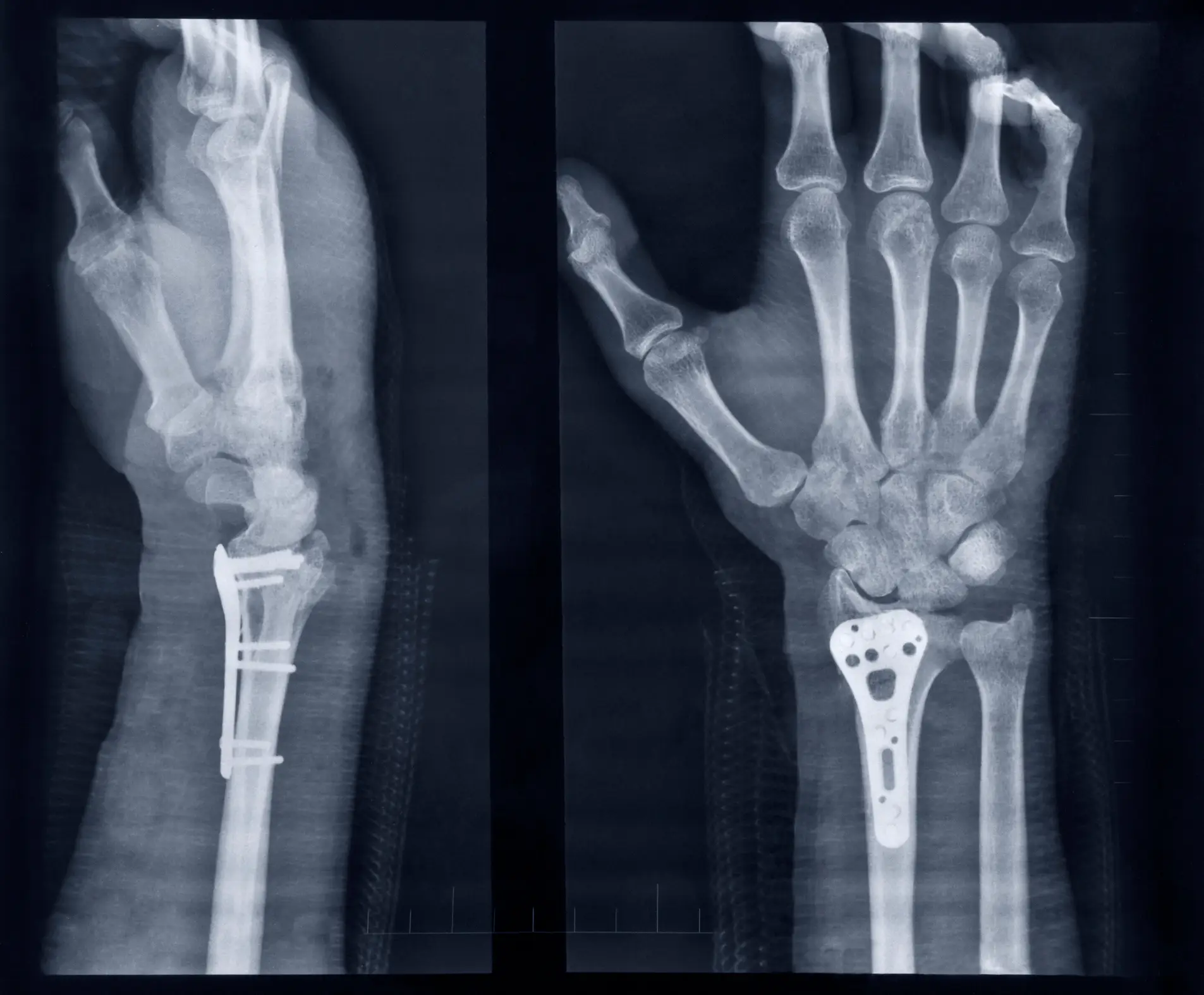 Bone glue could replace the need for plates and screws (Anilakkus/Getty Images)