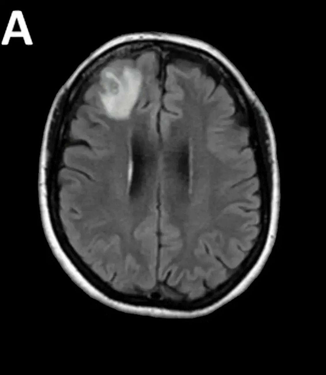 Scans had revealed alarmingly changes in the woman's brain.
