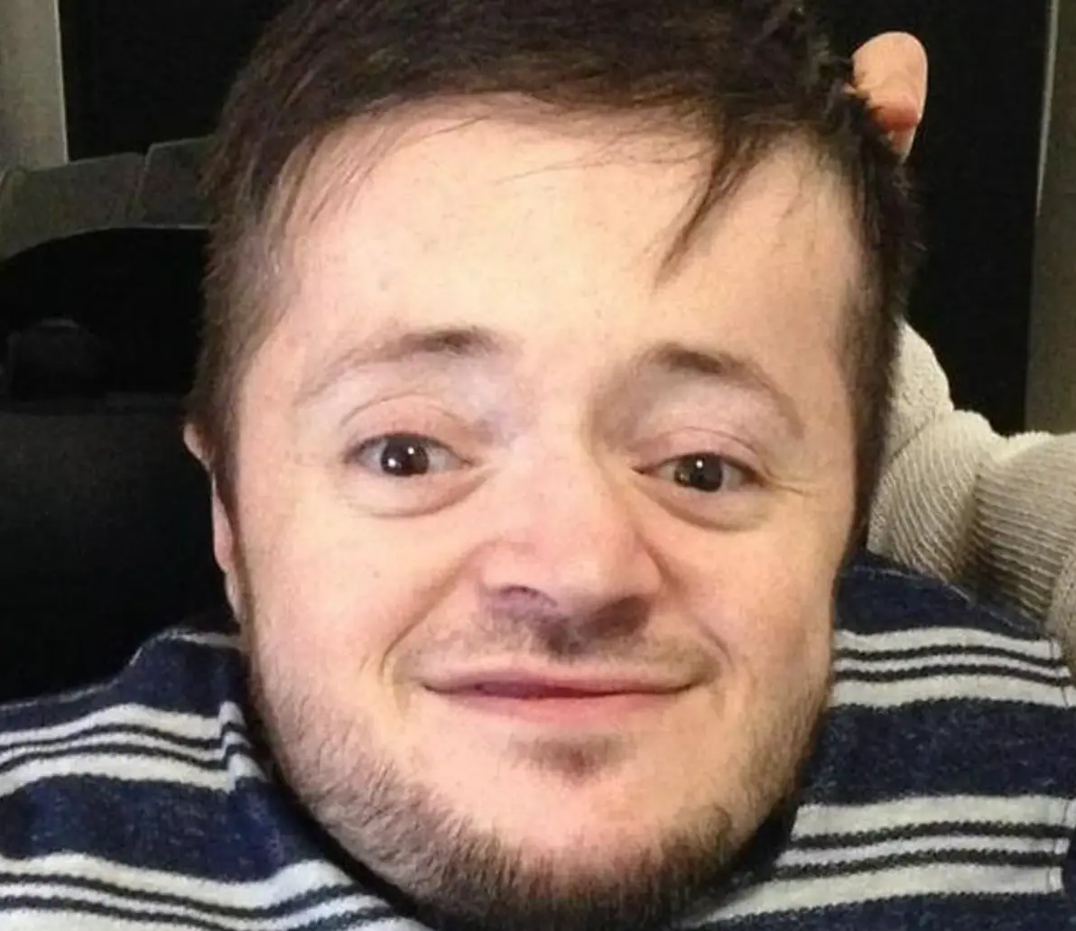 Joe Hall has had the condition since birth. (Imgur/Joe Hall)