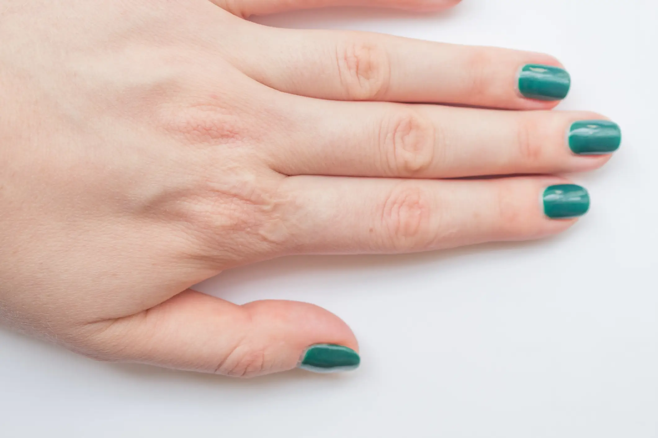 Another lesser-known symptom involves your nails (Getty Stock Image)