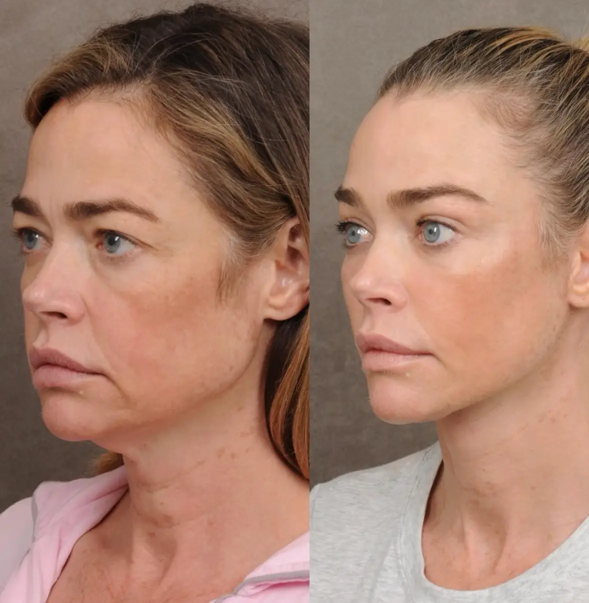 Richards shared before and after photos (Instagram/@drbentalei)