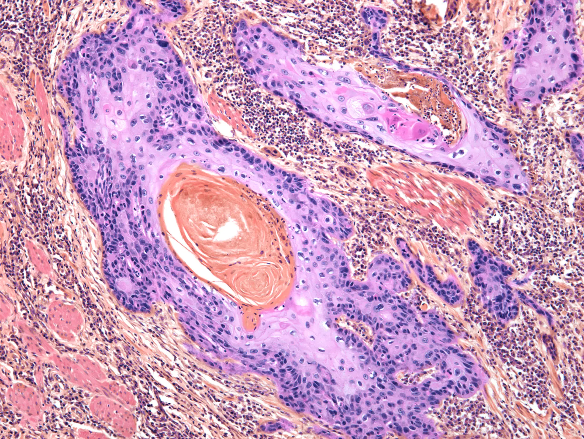 Squamous cell carcinoma can occur anywhere on the body (Getty Stock Photo)