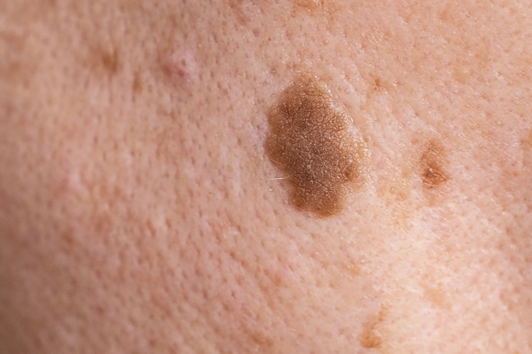Dr Amir's advice is built around something medical professionals call the ABCDE criteria, a checklist used when examining moles. (Getty stock image) (getty