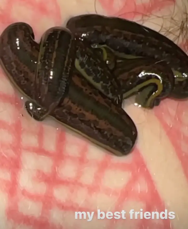 Leeches have been used as medicine since the ancient Egyptian times.