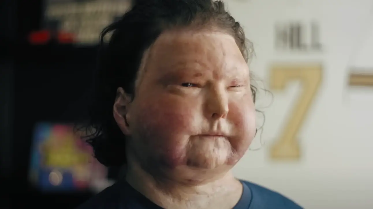 Man who survived world’s first successful face and double hand transplant reveals his 'afterlife' experience during 3-month coma