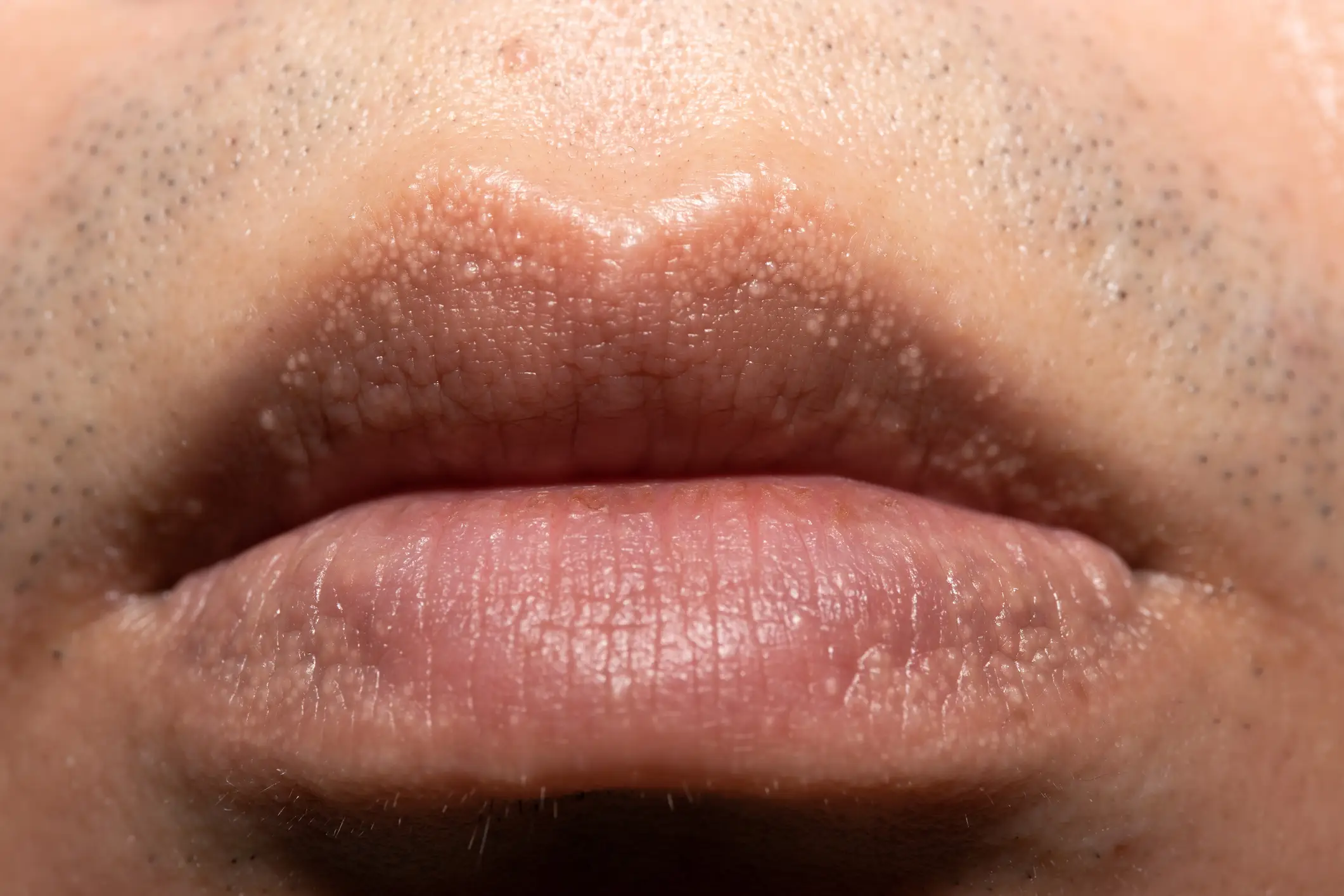 How Fordyce spots can look around the lips (Getty Stock Image)
