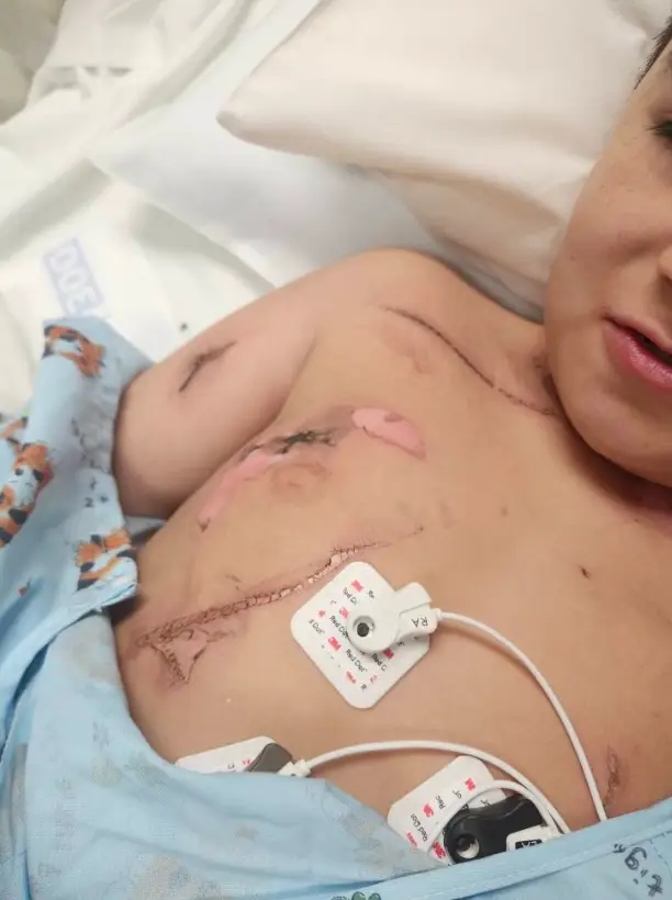 Lorenzo was left with burns on his neck and body (GoFundMe)