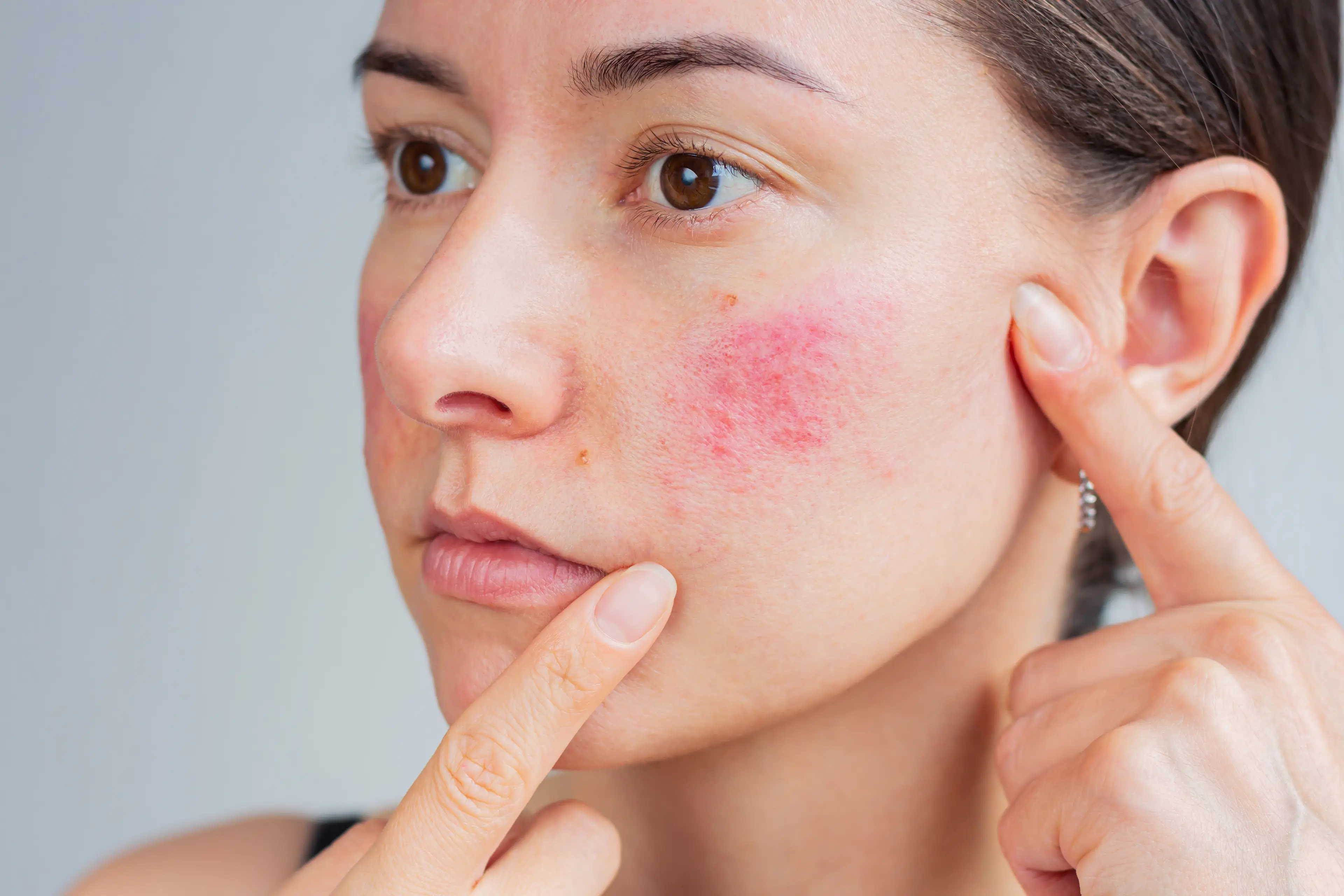 A facial rash is one of lupus' visible symptoms (Olga Shefer/Getty Images)