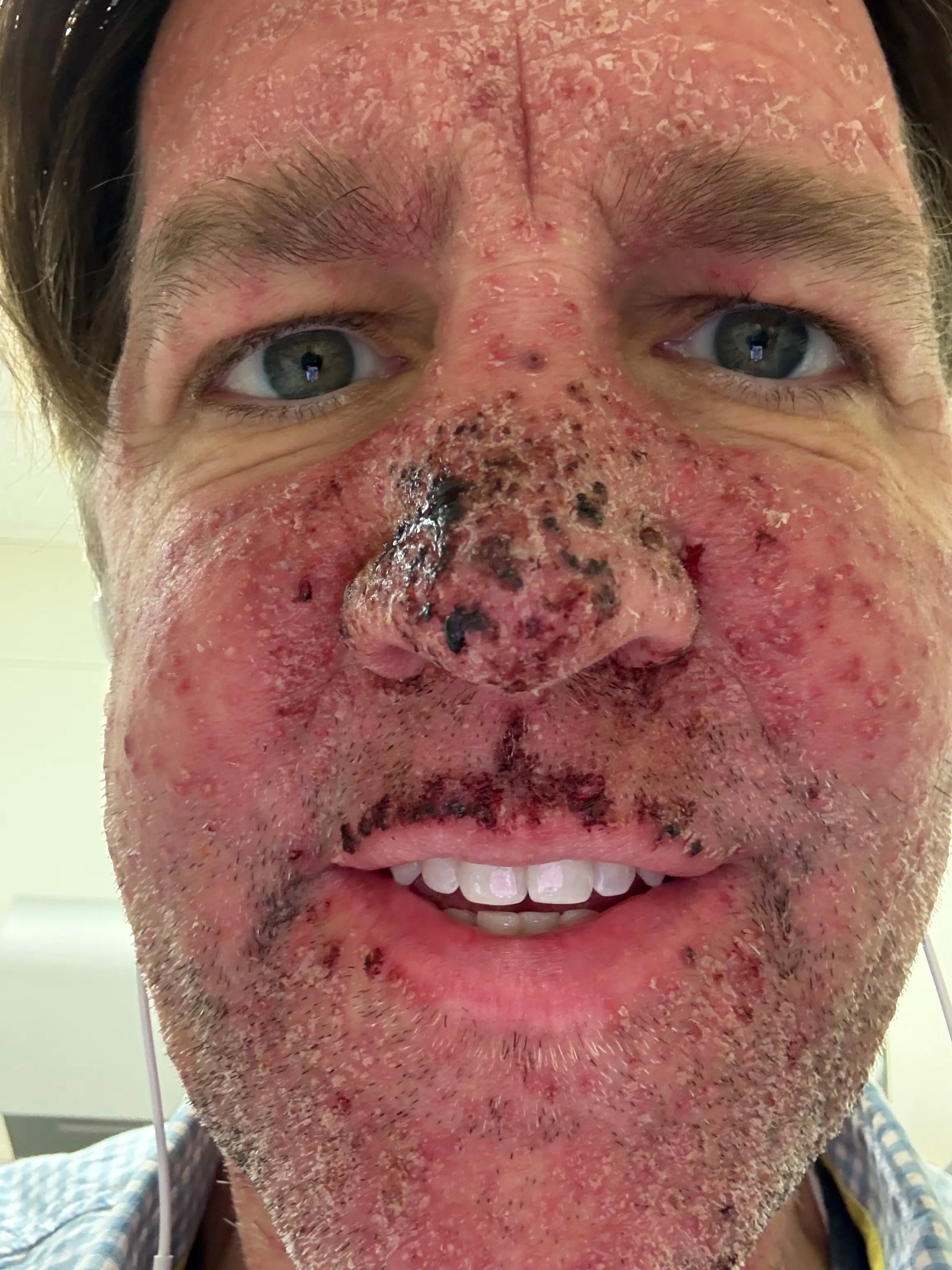 Ben Sasse's pancreatic cancer treatment left his face cracked and bloody (Ben Sasse/X)