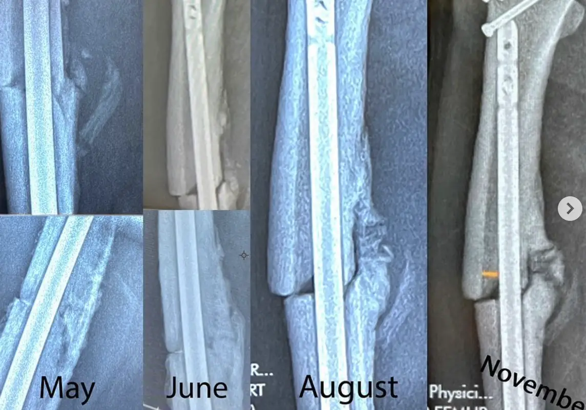 Hawk's leg requires surgery.