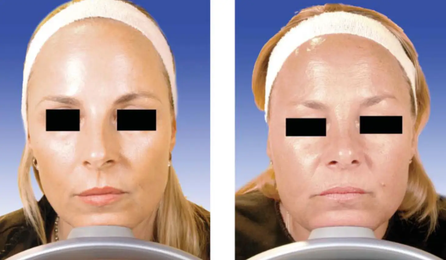 Twin 1 (right) appeared to have a fuller face and jaw after 19 years with minimal Botox (American Society for Dermatologic Surgery)