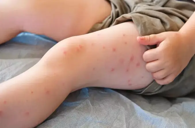 Measles can cause cold-like symptoms such as fever, cough, runny nose, and is typically followed by a blotched red rash (Getty Stock Image)