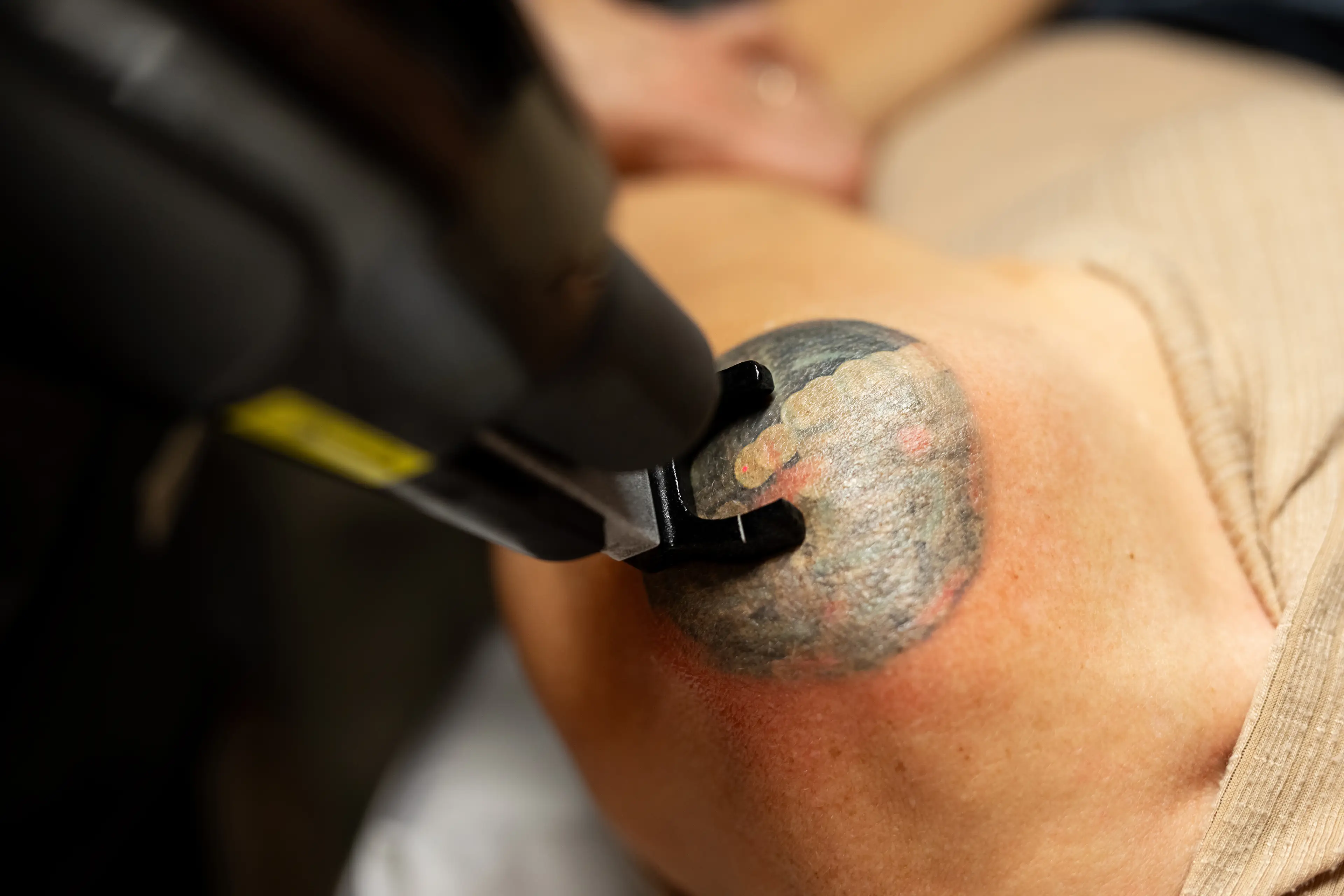 Laser tattoo removal shatters ink fragments using a high-intensity laser that targets pigment (Getty Stock Image)