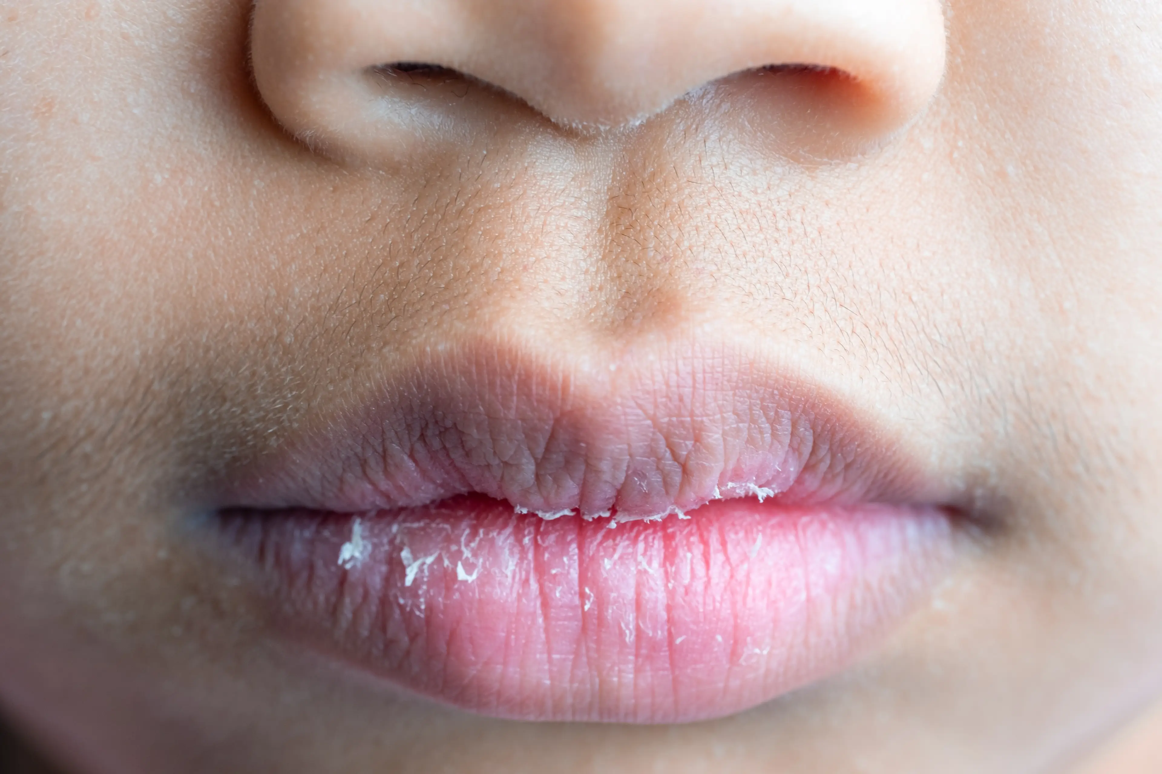 What actually causes chapped lips? (Prasit Supho/Getty)