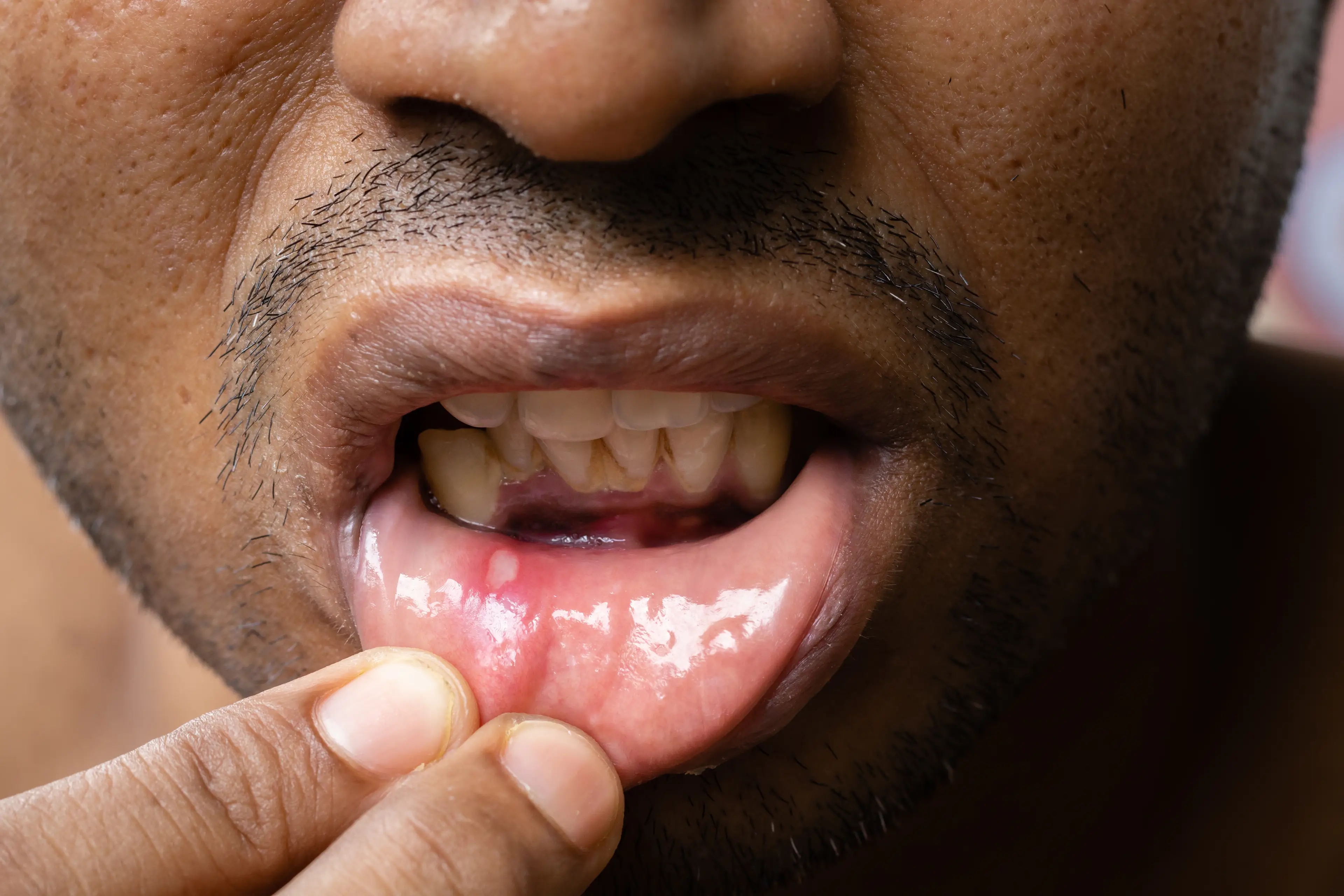 Do you have recurring mouth ulcers? (Getty Stock Images) 