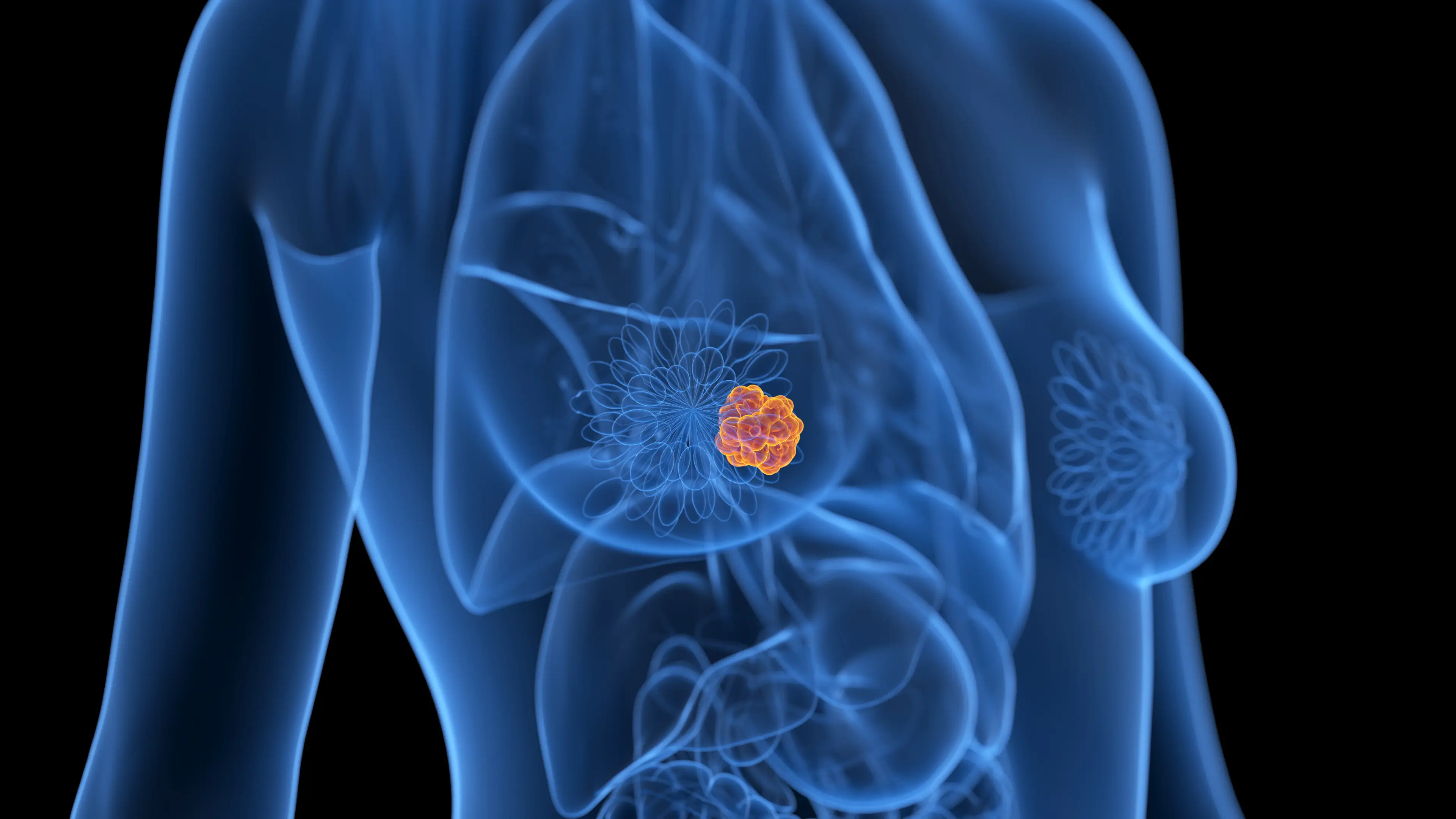 Vanessa is one of the 321,000 US women who will be diagnosed with breast cancer annually (SEBASTIAN KAULITZKI/SCIENCE PHOTO LIBRARY)