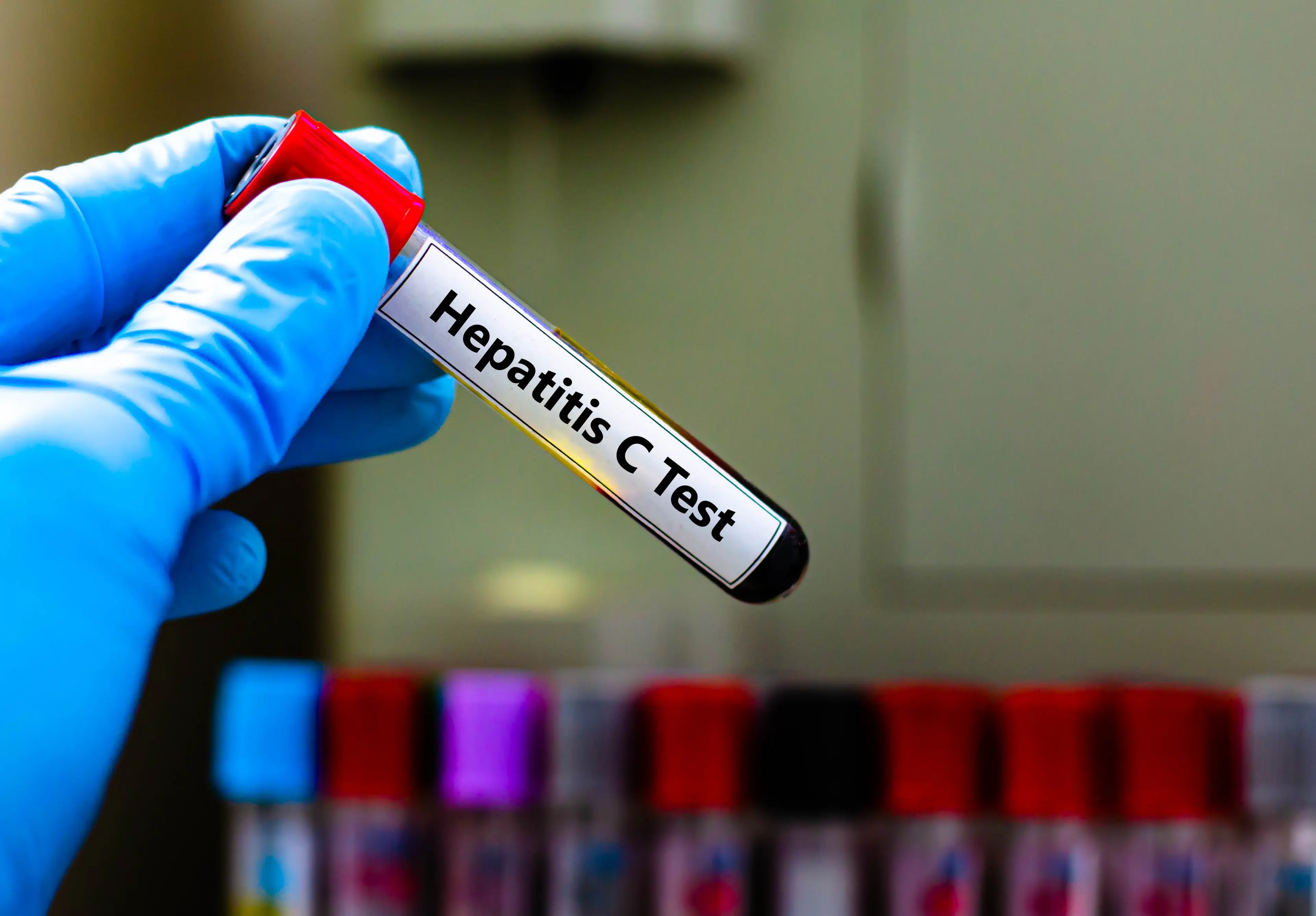 Hepatitis C can present no symptoms for years (Getty Stock Photo)