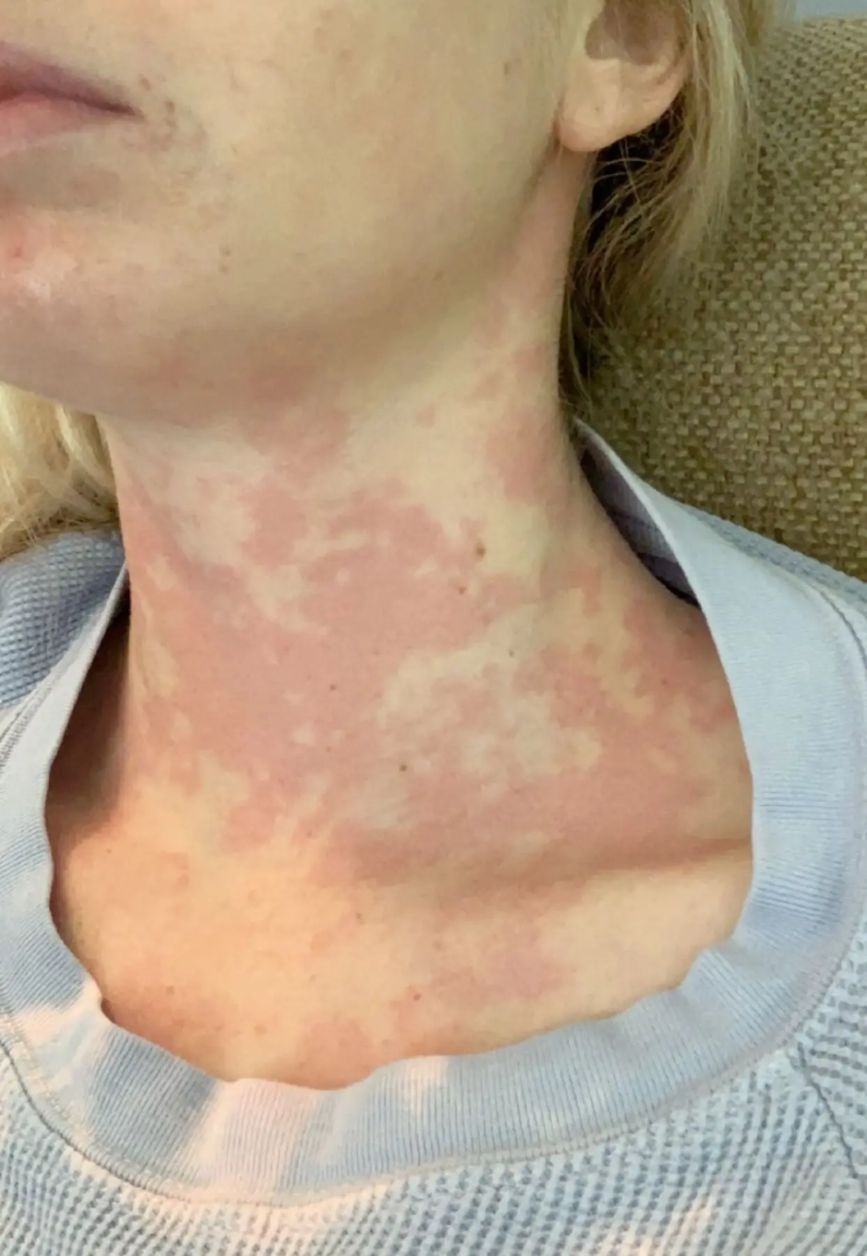 She can experience flare-ups (Jam Press)