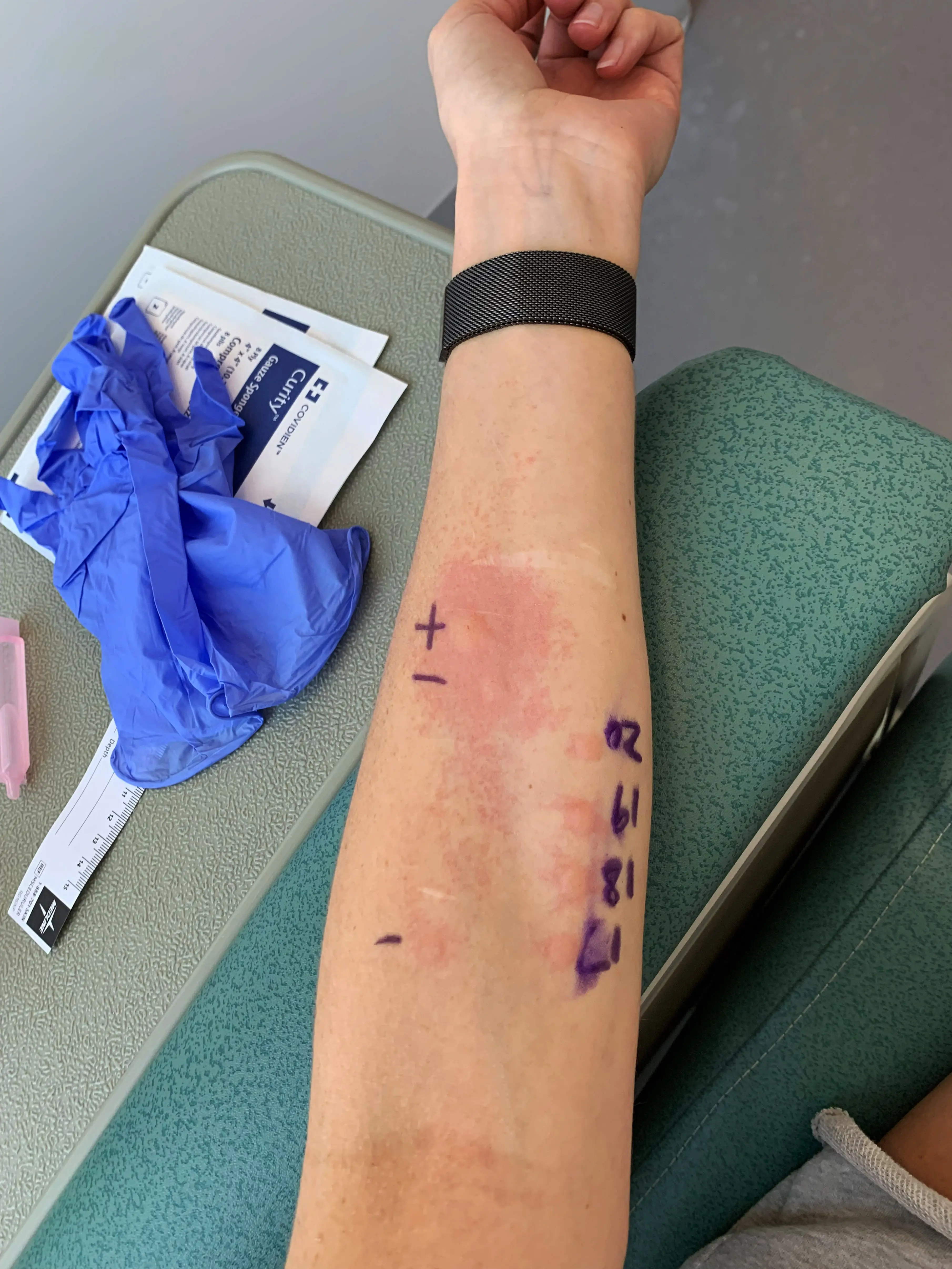 Allison has been tested for 160 allergens.