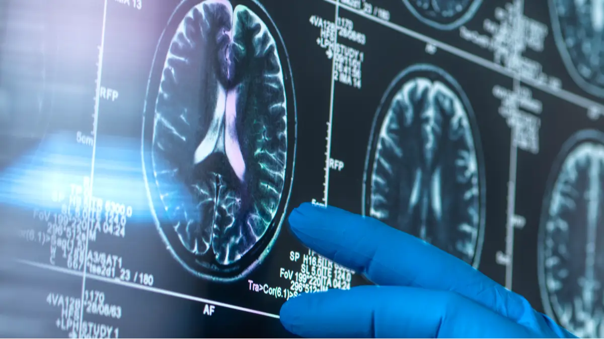 Doctor shares six vital but easy habits that could help prevent dementia later in life