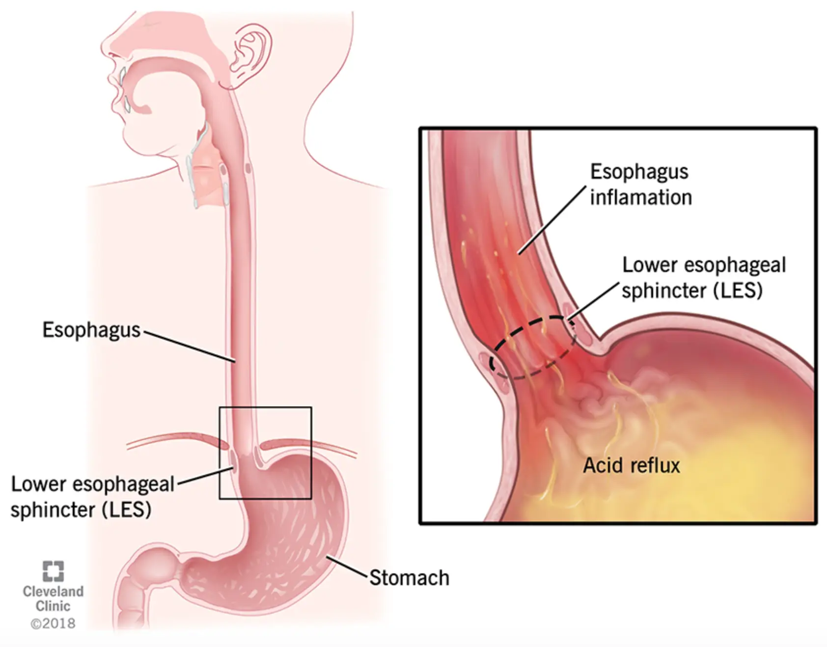 About 60 to 70 per cent of people with acid reflux have the typical symptom of heartburn meaning they may miss the cancer symptom (Cleveland Clinic)