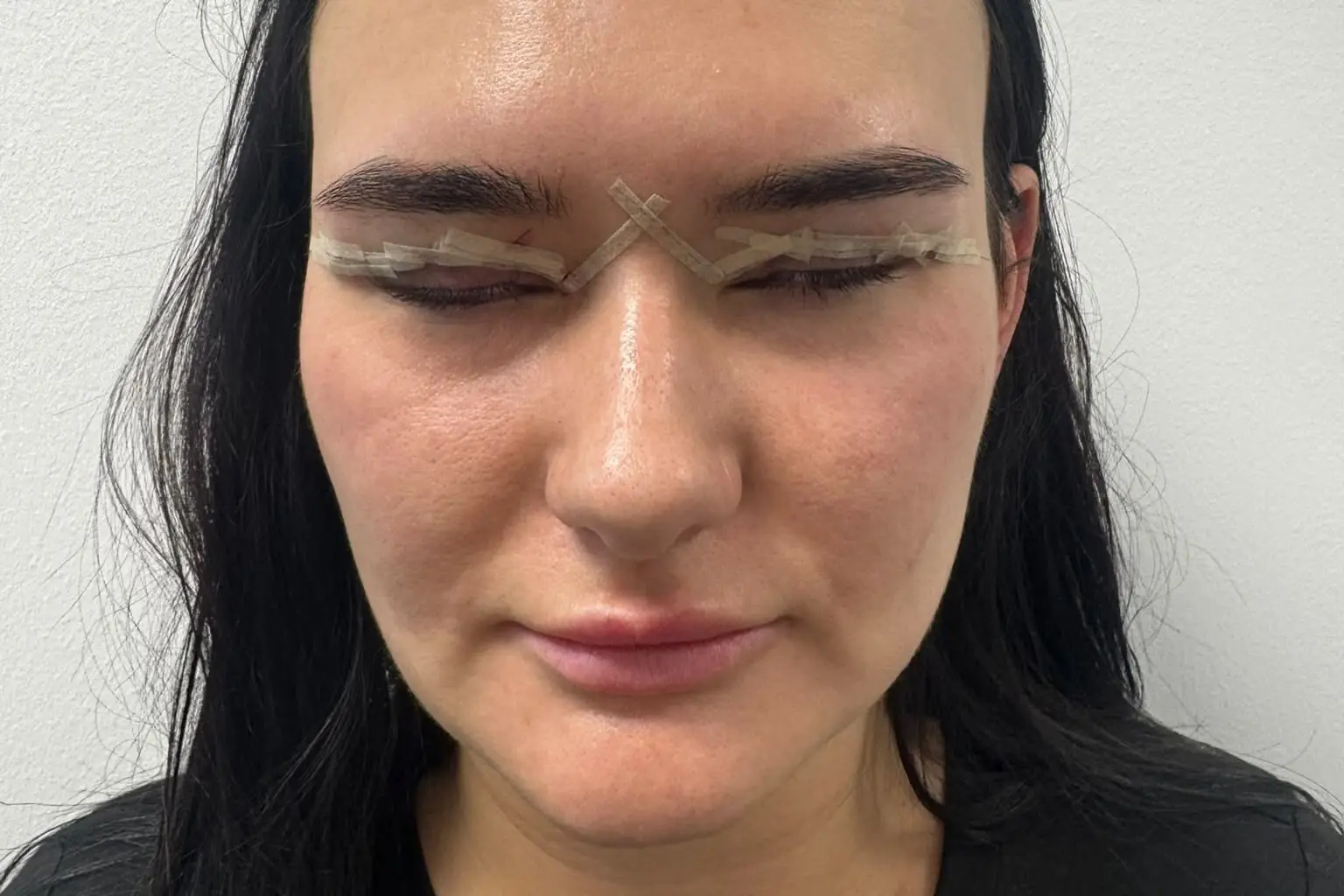 The 31-year-old was left to remove her own stitches. (SWNS)