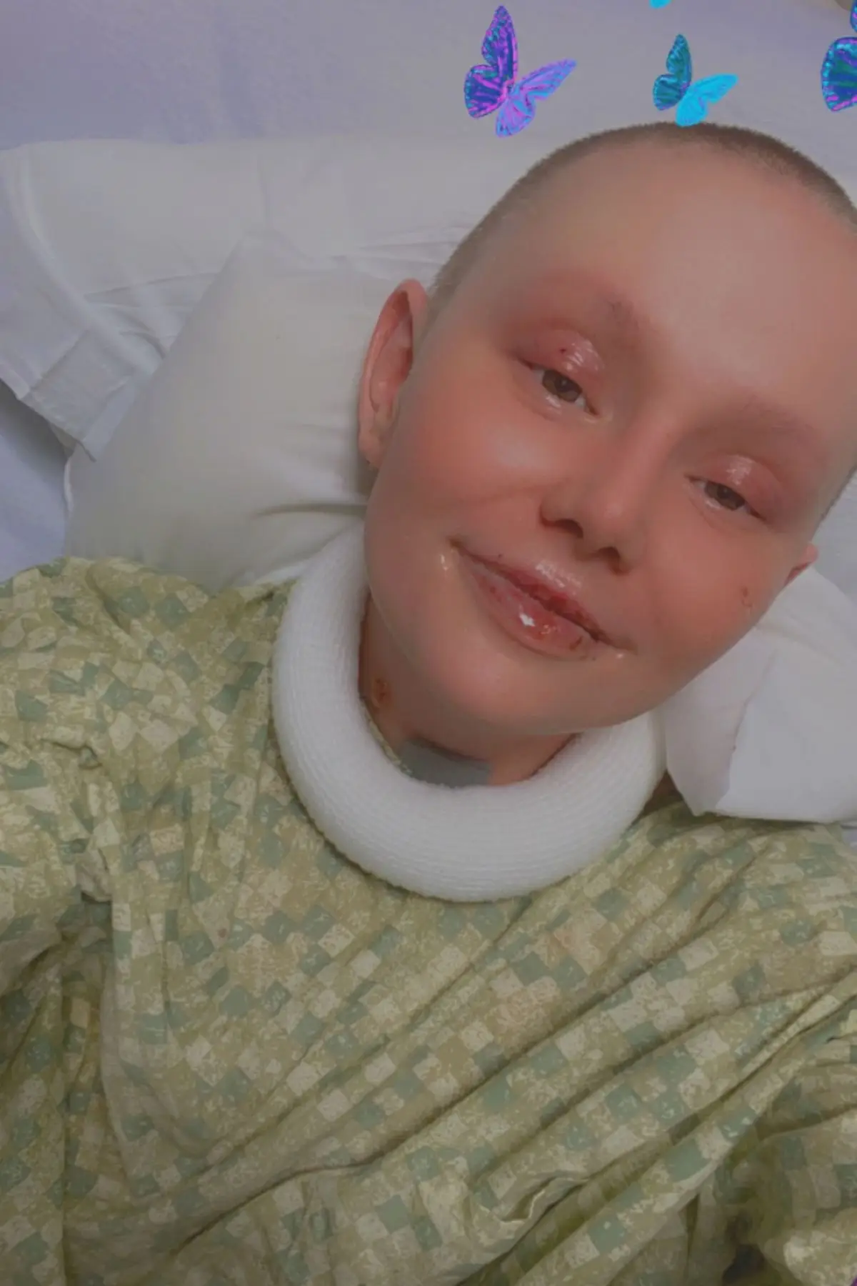 A mom experienced '95 percent' of her skin falling off after suffering a rare condition (Kennedy News)