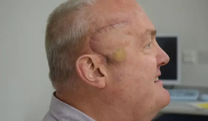His tumor shrank by 50 percent (University College London Hospitals NHS Foundation Trust)