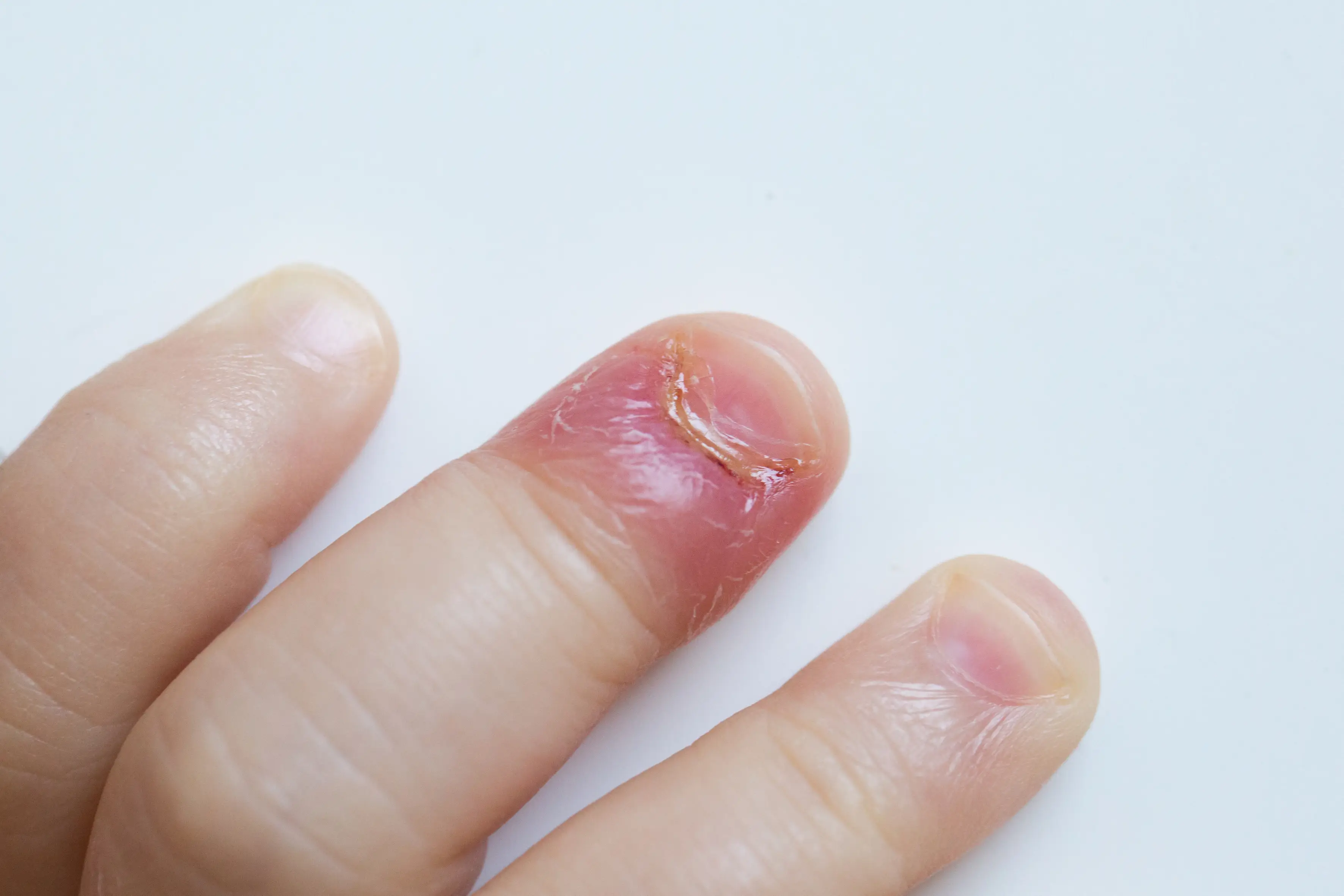 Paronychia is the name for the infection you can get around your fingernails if you bite them (Getty stock)