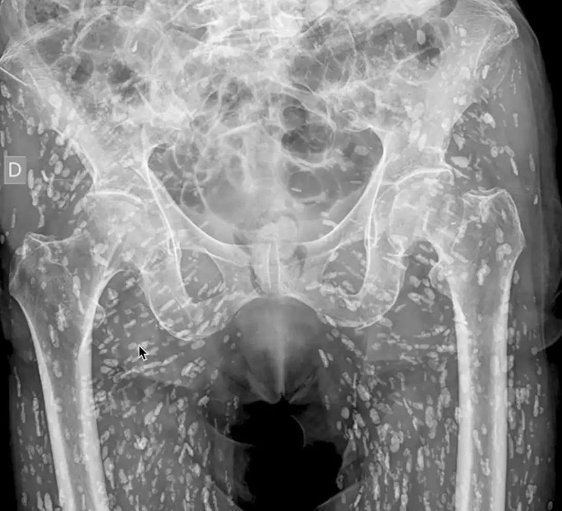 What it looks like when the cysts calcify on the body (EM_RESUS/Twitter)