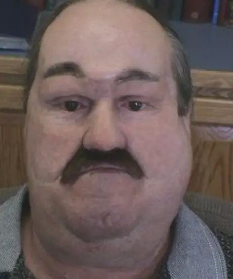 Mark Tatum's face was reconstructed with skin from his leg. (FindAGrave)