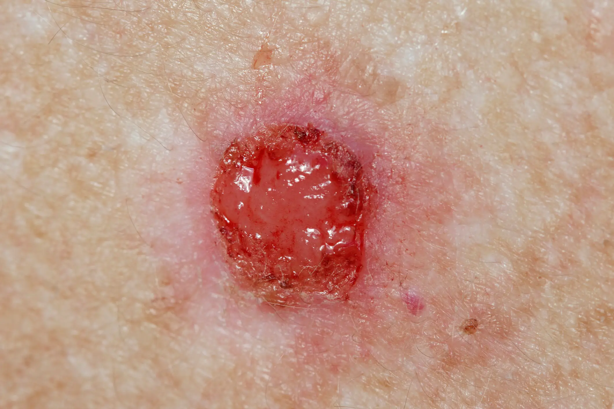 Basal cell carcinoma (BCC) is the most common form of skin cancer, according to Mayo Clinic, which occurs in the basal cells that produce new skin as old cells die off. (Getty stock image)