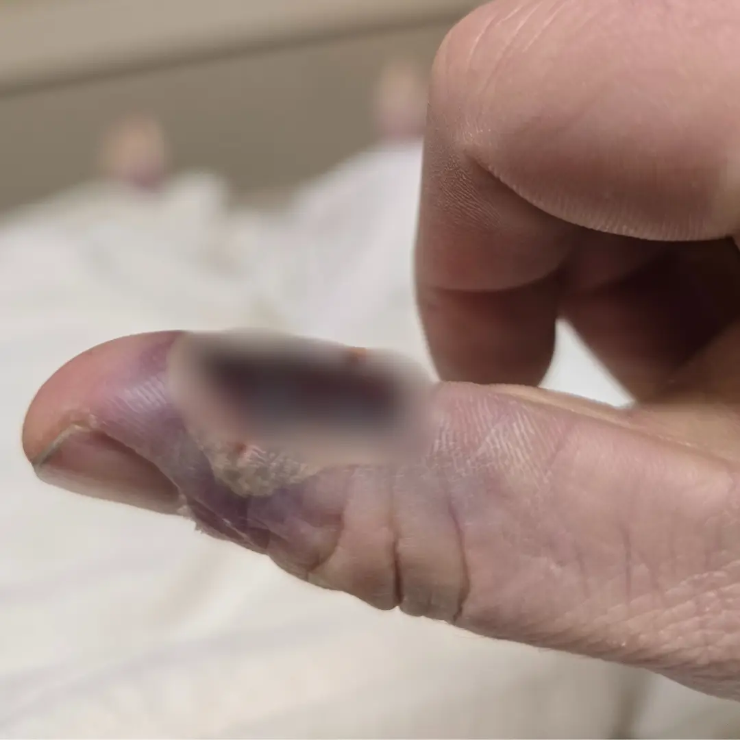 The burn to Max's thumb led to sepsis and a bilateral amputation (Max Armstrong / SWNS)