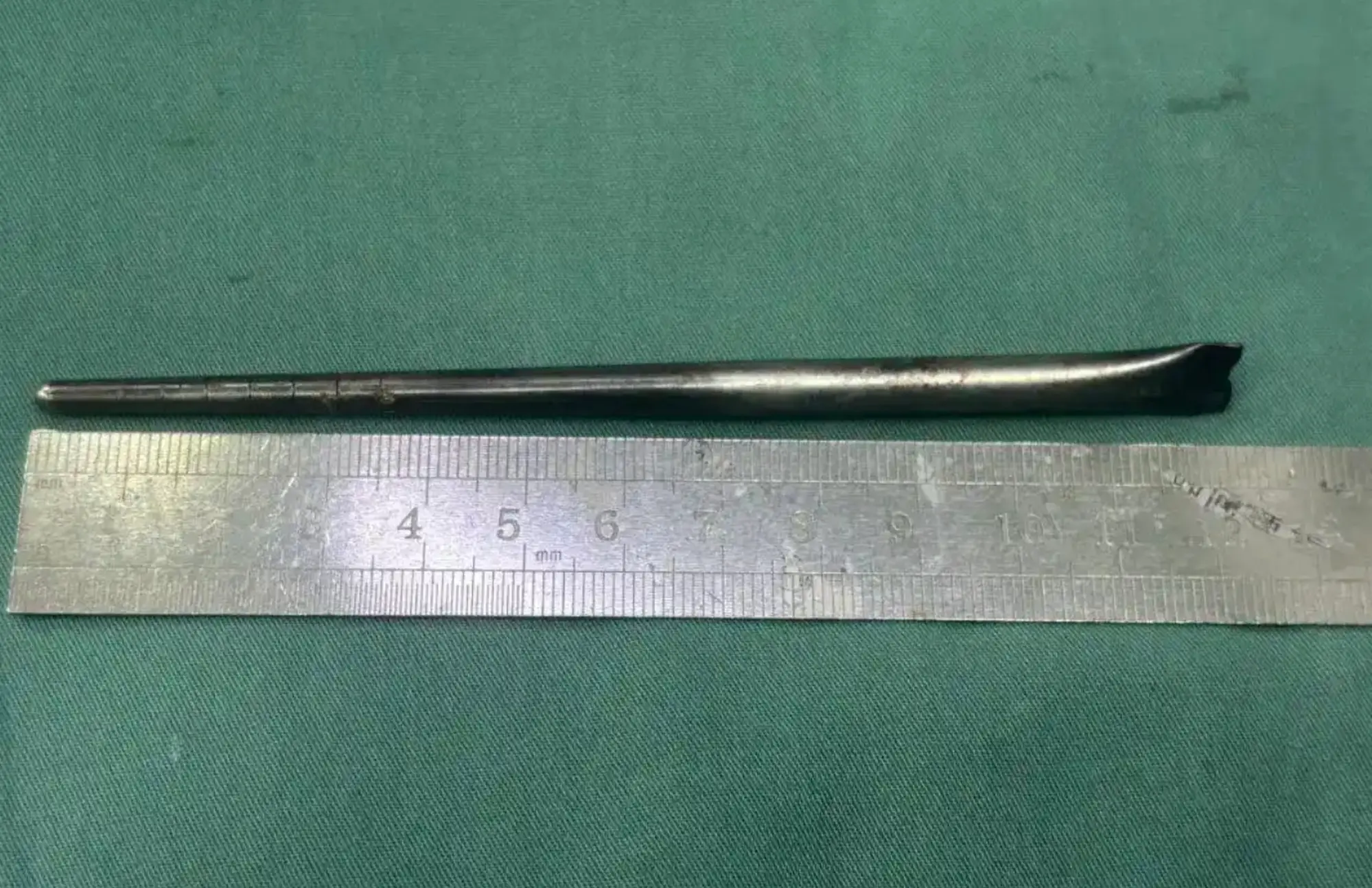The chopstick was stuck in Mr Wang's throat for eight years (CTS)