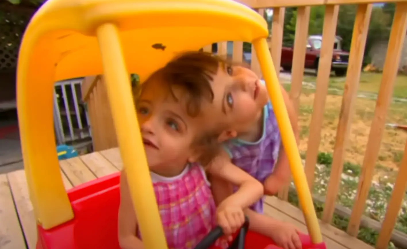 Krista and Tatiana are the only living conjoined twins in Canada. (60 Minutes Australia)