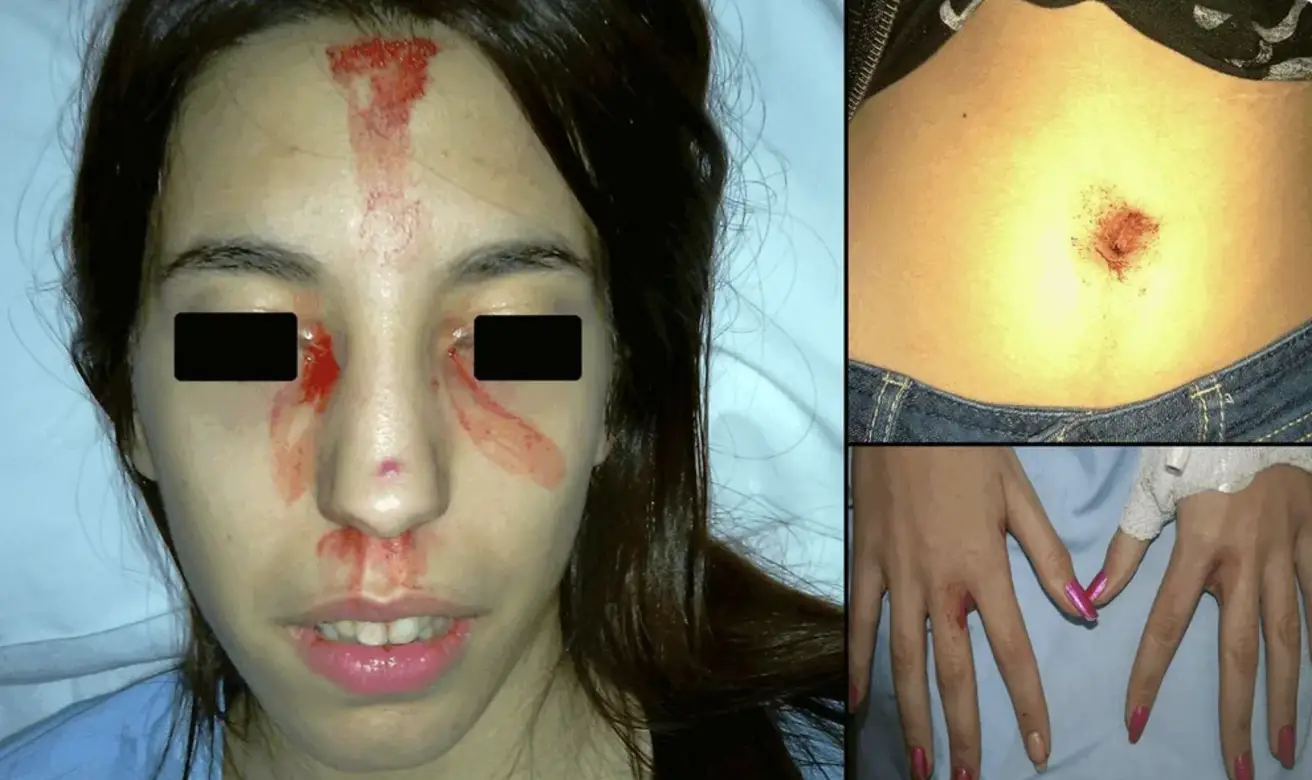 An unrelated case study of sweating blood was reported from Hospital General Universitario de Alicante in Spain.(Elvira Mora/Javier Lucas/Blood 2013)