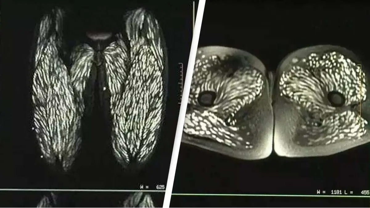 Horrifying scans show parasite-infested body of woman who'd been eating raw pork for 10 years