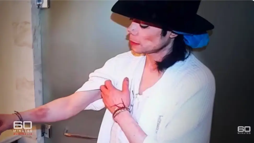 Dominic Cascio alleges that he made the bruises Jackson said were caused by police (60 Minutes Australia)