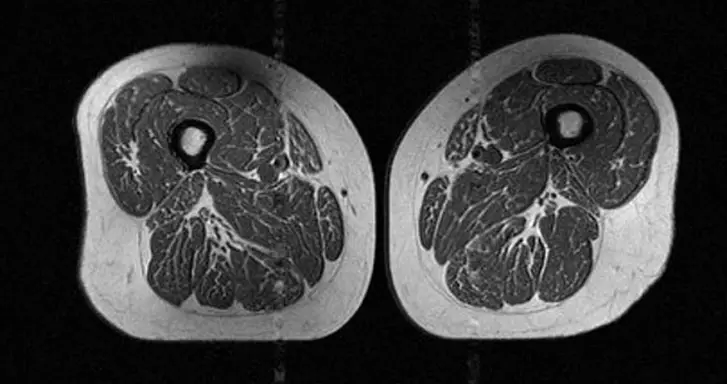 An MRI of a 62-year-old woman - 87% of her diet is UPFs (Radiology)