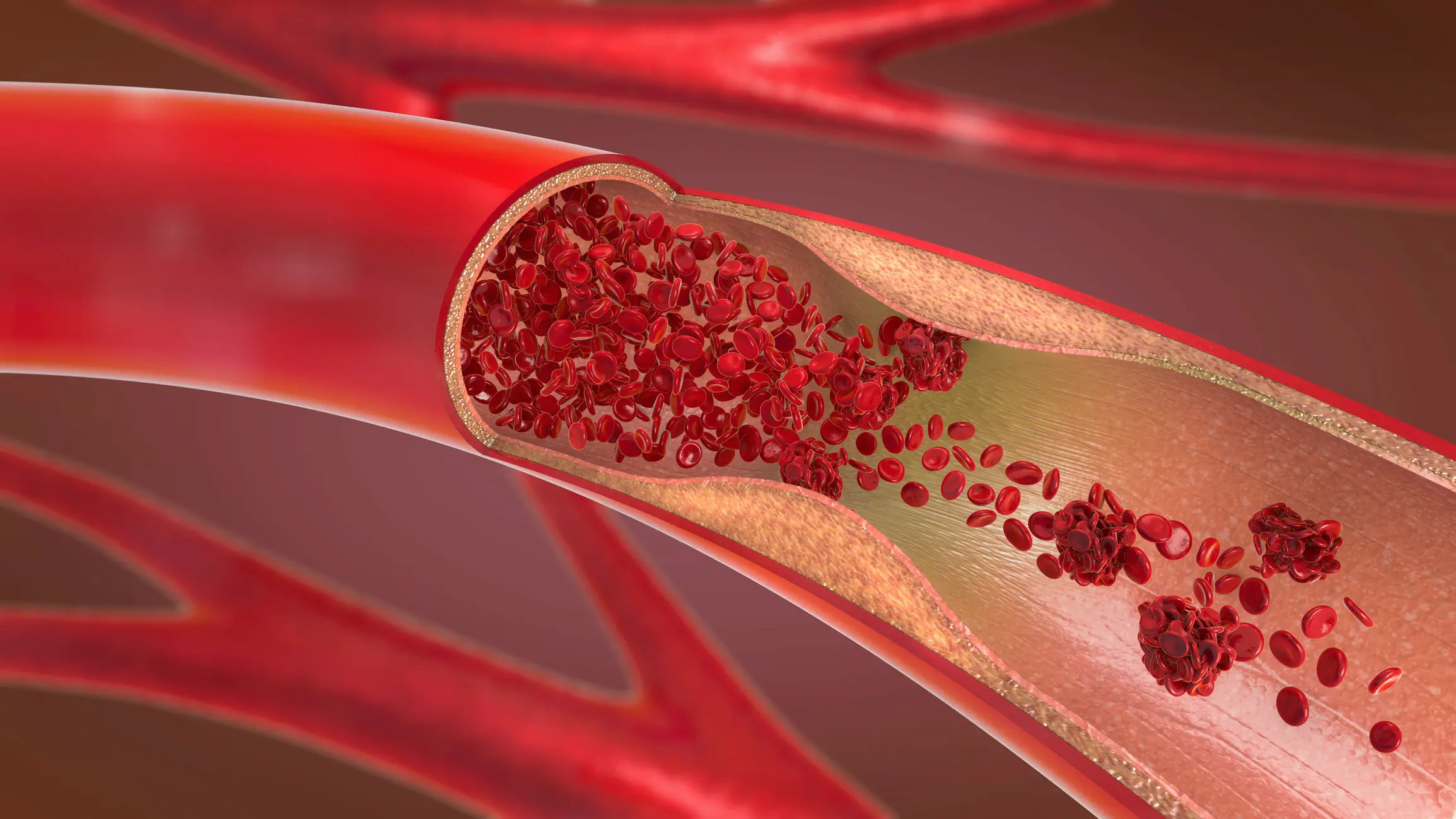 Narrowing, stiffening and blocking of the arteries leads to the condition (CHRISTOPH BURGSTEDT/SCIENCE PHOTO LIBRARY)