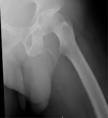 Doctors were concerned the man had injured his hip (Urology Case Reports)