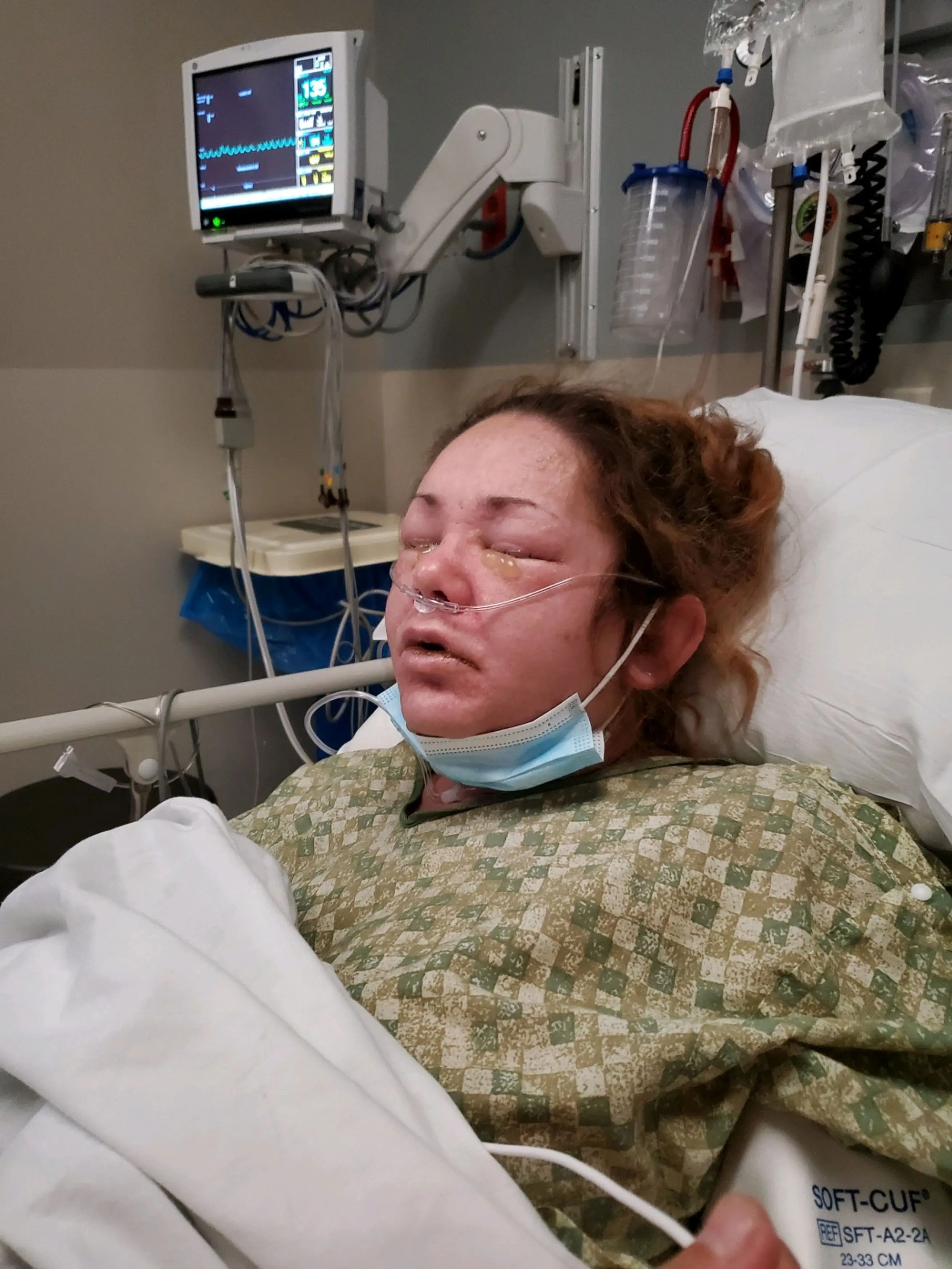 95 percent of her skin fell off (Kennedy News)