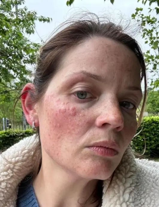 The mum-of-three takes four tablets a day to manage her skin disorder, but admits the pills don't always work (ITV)