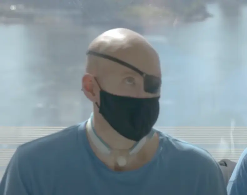 Aaron James lost his nose and lips in the incident.