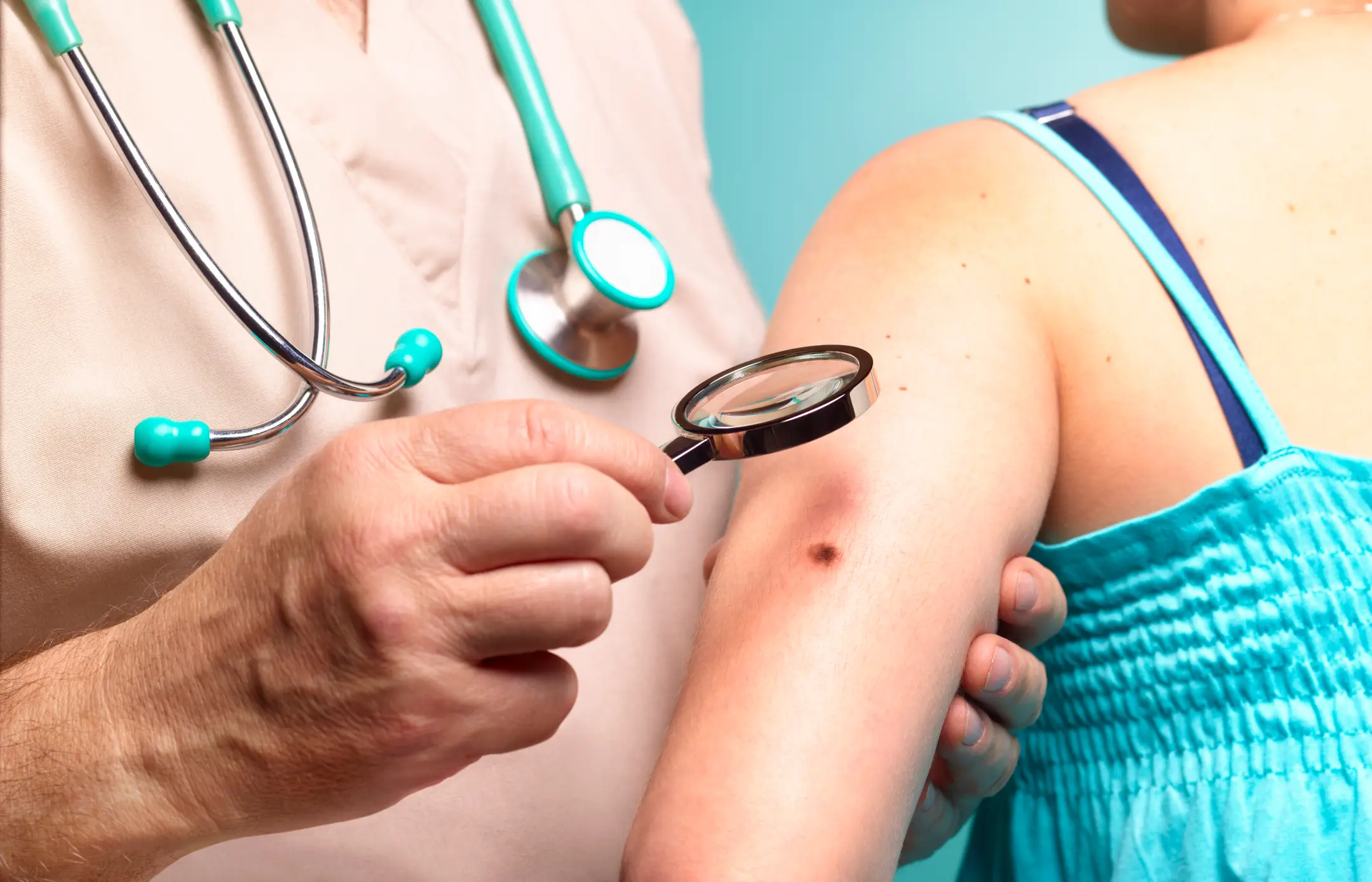 The American Cancer Society puts the lifetime risk at 1 in 33 for white people, compared with just 1 in 1,000 for Black people, largely because lower melanin levels offer less protection from UV damage. (Getty stock image)