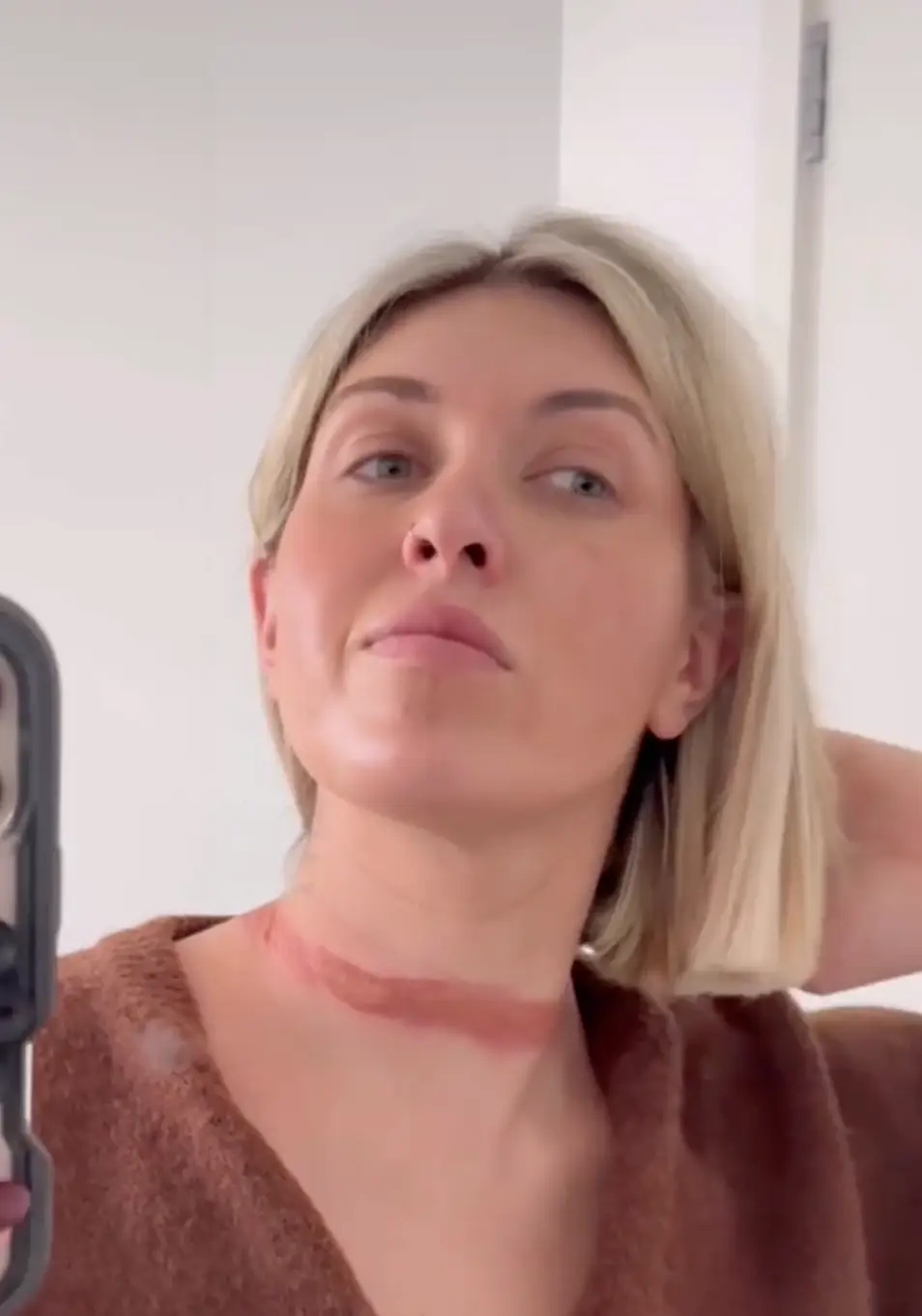 Fashion influencer Eli Moulton's severe scarf burn (eli__moulton@Instagram)